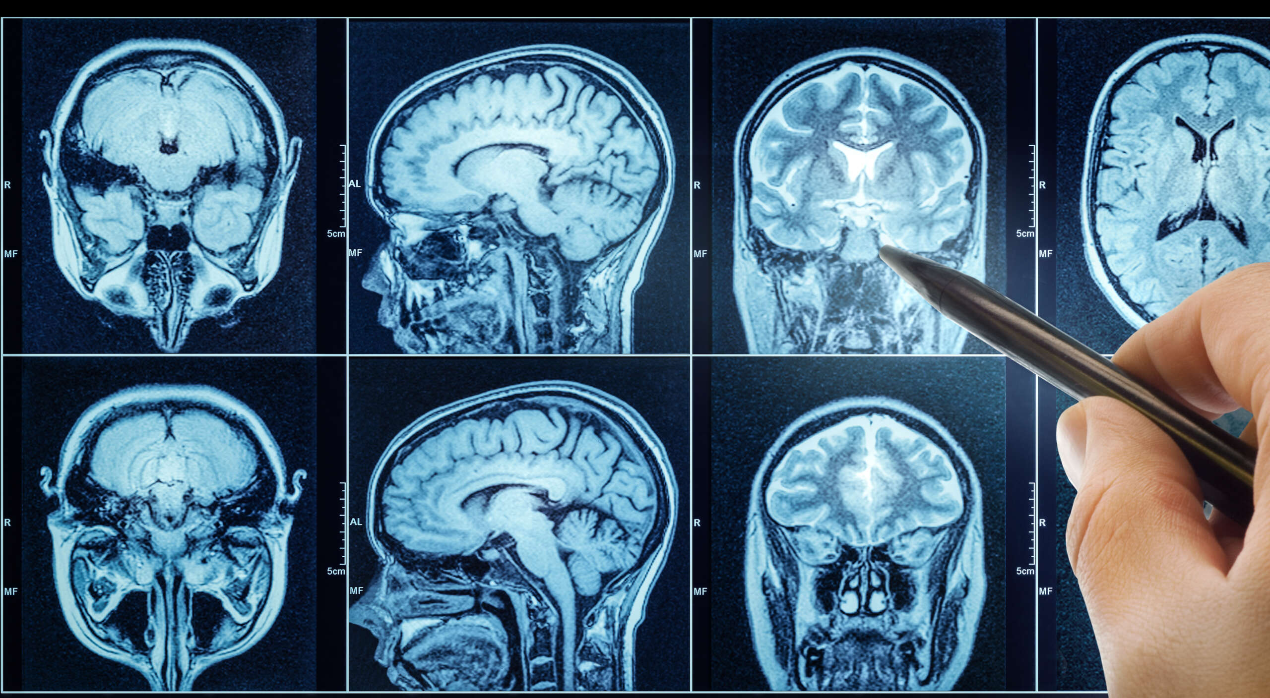 Mit neuer MRT-Technik lassen sich Gehirnschäden bei Long COVID nachweisen